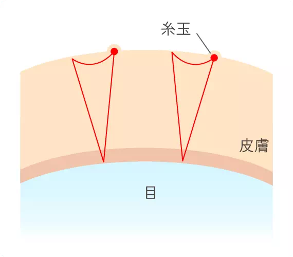 二点留め（スクエア法）
