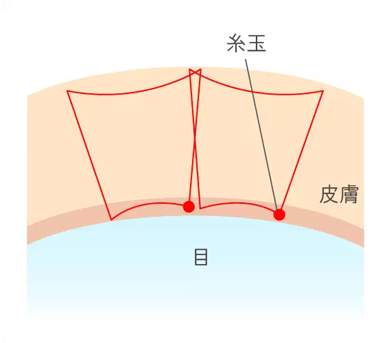 二重裏留め法（ダブルアンカー法）