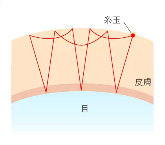 線留め（自然癒着法 / 4点・6点）